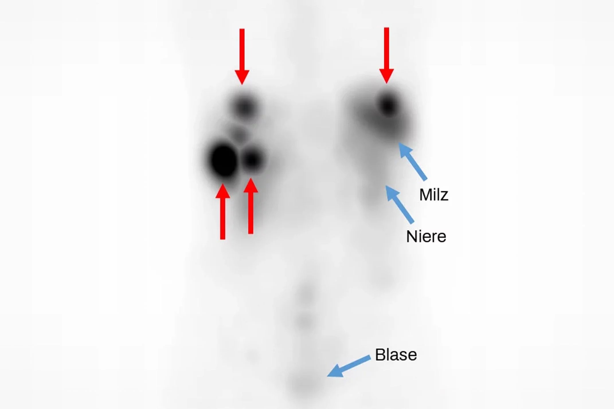 The nuclear medicine image taken seven days after administration of the new radioactive drug Tb-DOTA-LM3 shows a high specific accumulation of the active substance in the liver tumours (red arrows) with simultaneous low accumulation in the organs (blue arrows). These are good prerequisites for highly effective therapy with few side effects.