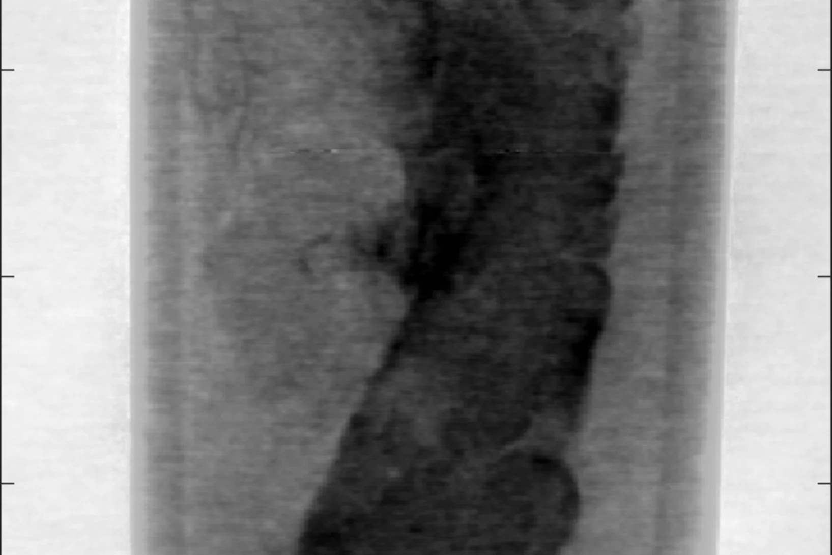 Reconstructed slice of X-ray phase contrast microtomography from a human breast biopsy tissue, suspected of being affected by tumour development.